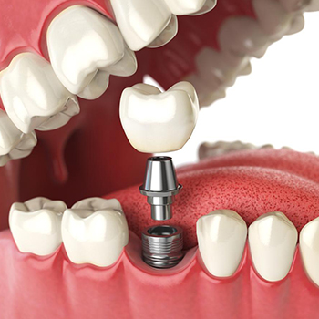 Dental Implants in Vijayawada