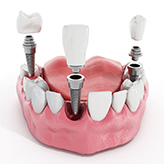 dental implants in Vijayawada