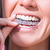 Invisalign Aligners in Vijayawada