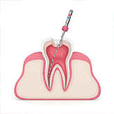 root canal treatment in Vijayawada