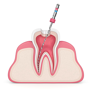 Root Canal Treatment in Vijayawada