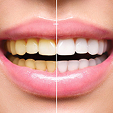 Teeth Whitening in Vijayawada